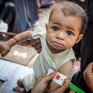 Malnutrition in Children